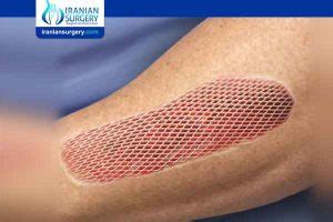 Skin grafting | What is skin grafting? | Iranian Surgery