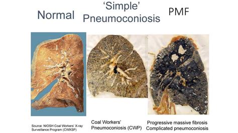 Black Lung Study Finds Biggest Cluster Ever Of Fatal Coal Miners ...