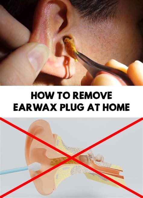 When too much wax is collected in the ear, a plug forms, sometimes causing hearing problems ...