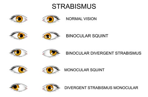 Strabismus | Eye Patient