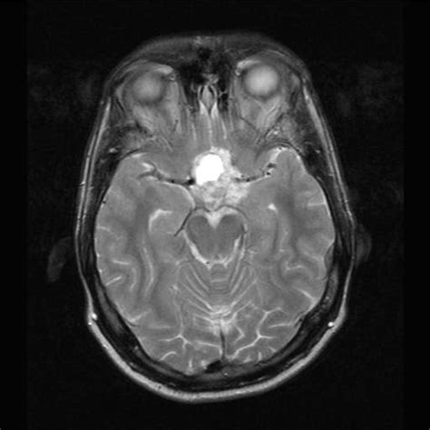 Craniopharyngioma MRI - wikidoc