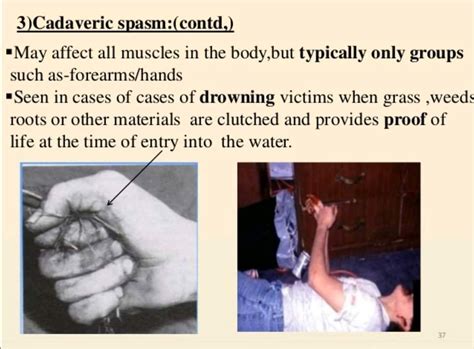 Cadaveric spasm Cadaveric spasm is... - ریاست خدمات طب عدلی