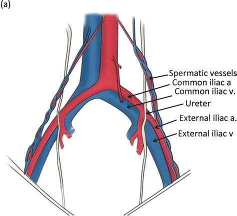 Common Iliac Vein Anatomy