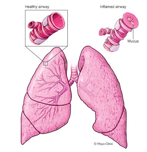 Asthma attack - Mayo Clinic