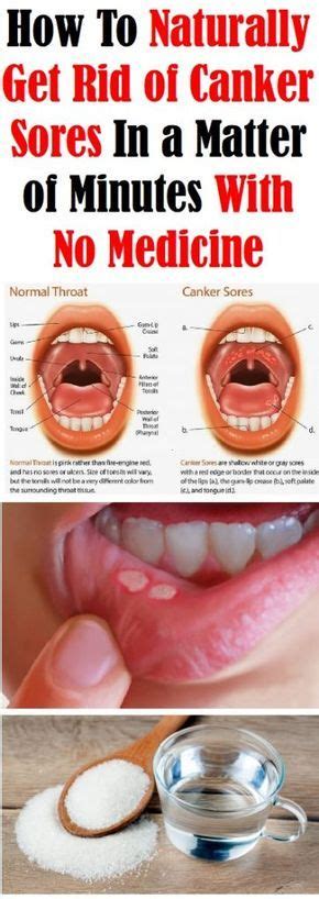 Canker sores are referred to as aphthous ulcers and are a very common oral issue. They might be ...