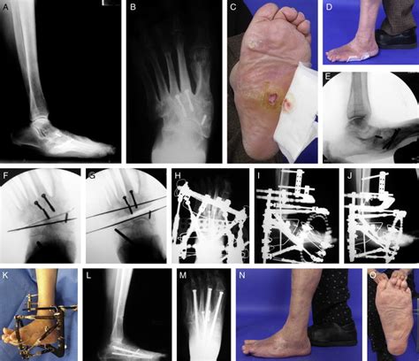 A Two-Stage Percutaneous Approach to Charcot Diabetic Foot Reconstruction - The Journal of Foot ...