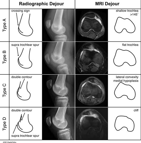 Are the Current Classifications and Radiographic Measurements for Trochlear Dysplasia ...