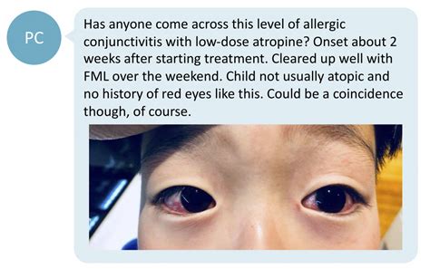 Atropine eye drops and ocular allergy - what's the cause? - Myopia Profile