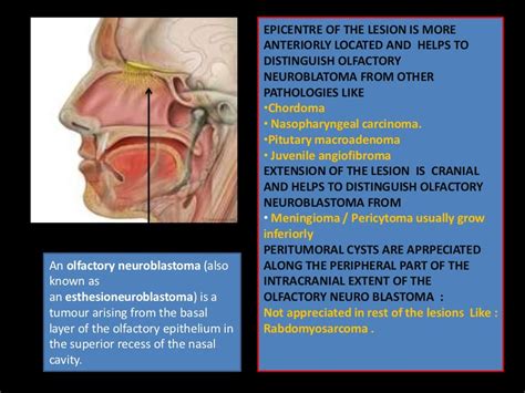 Olfactory neuroblastoma