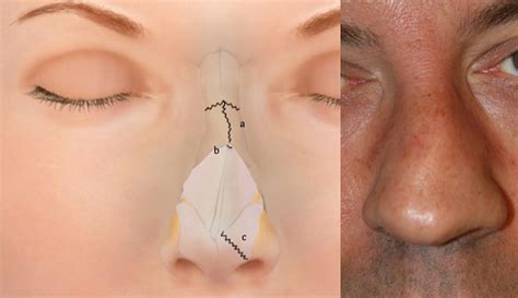 Nasal Fracture - Facial Trauma