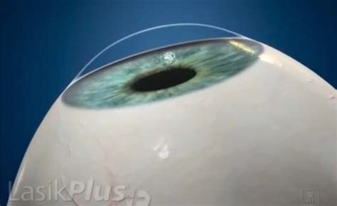 PRK Laser Eye Surgery [PRK vs LASIK] - LasikPlus | Eye surgery, Prk eye surgery, Lasik eye surgery