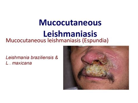 Leishmaniasis. Department of Infectious Diseases Leishmaniasis - online ...