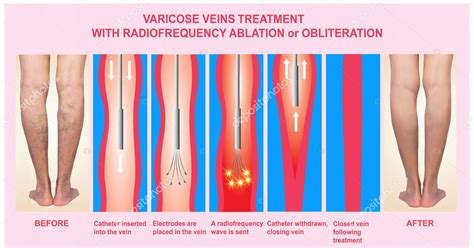 Varicose Veins and Treatment with radiofrequency ablation - UDAI OMNI ...