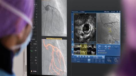 Advanced IVUS Imaging Technology | Philips