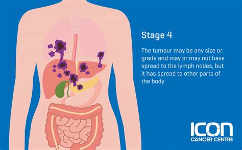 What is Soft Tissue Sarcoma? Soft Tissue Sarcoma Explained — Icon Cancer Centre