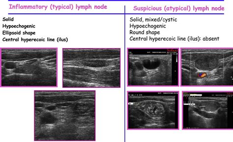 Figure 1 from Role of thyroid ultrasound in the diagnostic evaluation ...