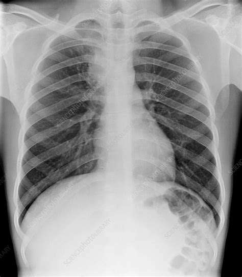 Tuberculosis Chest X Ray Findings