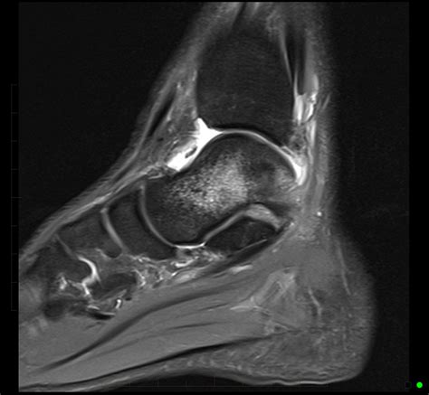 mri-ankle-anterior-talofibular-ligament-rupture-2 - MRI at Melbourne Radiology Clinic