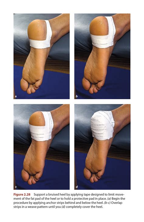 Shin Splints - Taping Techniques | Human Kinetics Blog