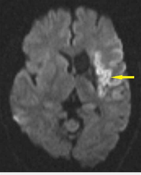 MRI brain axial DWI showing large acute infarct involving the left... | Download Scientific Diagram