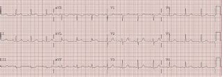 Dr. Smith's ECG Blog: The Same Theme: Large Lateral STEMI is Subtle on the ECG