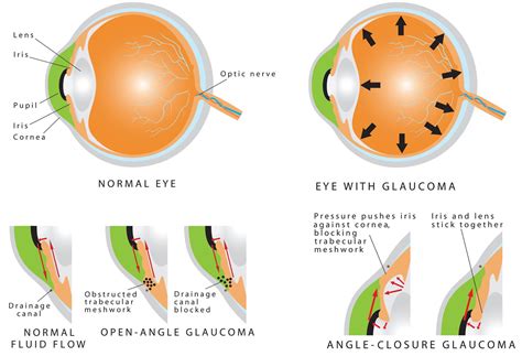 Types of Glaucoma - Glaucoma Associates of Texas