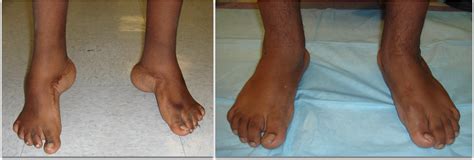 clubfoot surgery adult and pediatric ilizarov — Foot & Ankle Surgery