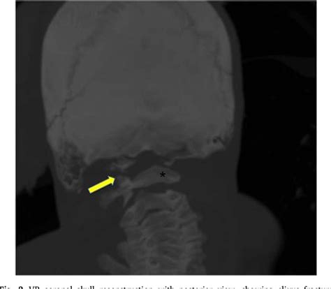 Figure 3 from Utility of post mortem computed tomography in clivus ...