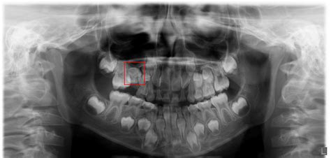 Panoramic x-ray of mixed dentition, can't figure out which tooth this ...