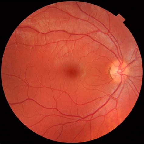 Fundus photography - Wikipedia