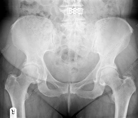 Osteoarthritis of hip joint, X-ray - Stock Image - C002/9629 - Science Photo Library