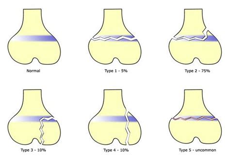 Salter Harris Phalanx Fracture