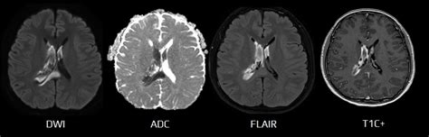 MR-DWI in the acute stroke diagnosis | STROKE MANUAL