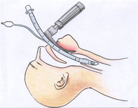 Vocal Injury from Intubation - Los Angeles ENT Doctors ENT Specialists ...