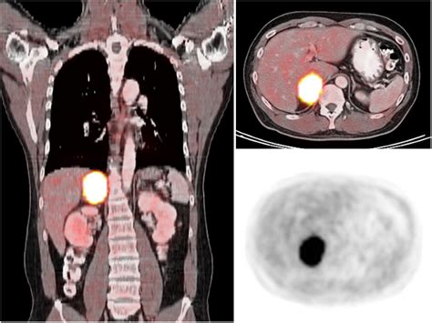 18F-FDOPA PET and PET/CT Accurately Localize Pheochromocytomas ...