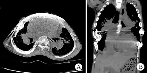 (A) and (B) Postoperative CT scan of thorax. | Download Scientific Diagram