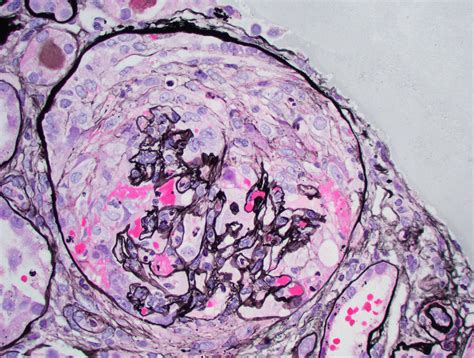 An Elderly Man With Rapidly Progressive Glomerulonephritis - Renal and Urology News