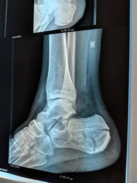 Non-displaced calcaneus fracture : r/orthopaedics