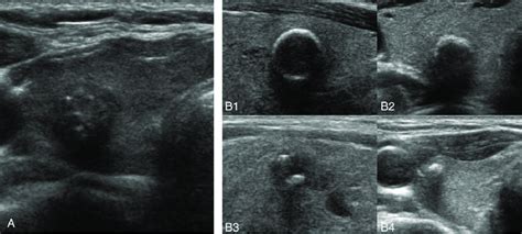 Spongiform Nodule Ultrasound