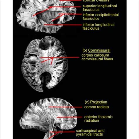 Selected (a) association, (b) commissural, and (c) projection white... | Download Scientific Diagram