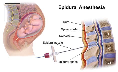 Sensors | Free Full-Text | Recent Advances in Smart Epidural Spinal Needles