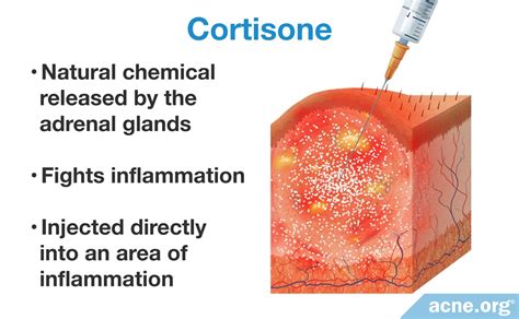 Cortisone Shots for Acne - Acne.org