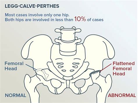 Legg-Calve-Perthes Disease | Burlington Orthotic Centre