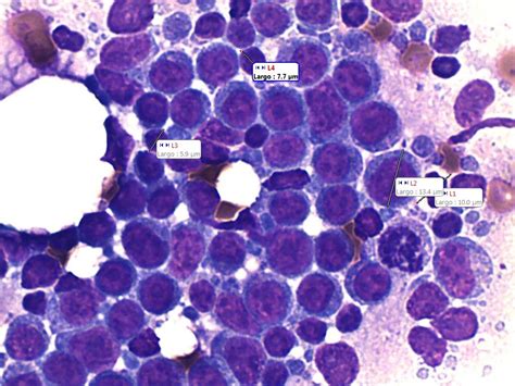 Giant cell lymphoma b, CD21 cytology taken and interpreted by Renato ...