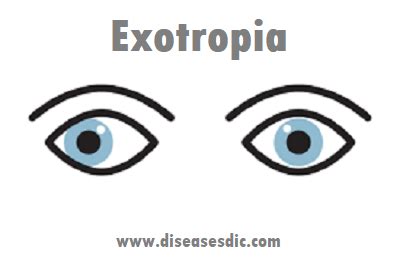 Exotropia – Symptoms, Management, and Prevention