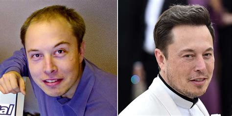 How Elon Musk Got His New Look With Hair Transplantation - Pristyn Care