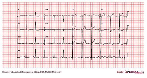 Left ventricular hypertrophy EKG examples - wikidoc