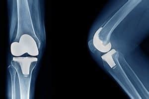 DePuy Attune Knee Replacements Fail due to Adhesion Issues