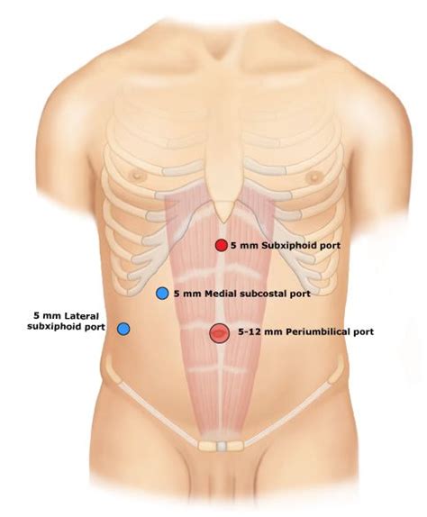 Laparoscopic Cholecystectomy