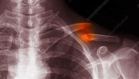 Clavicle Fracture, X-ray - Stock Image - C027/2618 - Science Photo Library